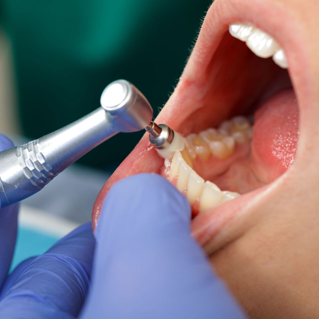 Higienista Dental en Estados Unidos